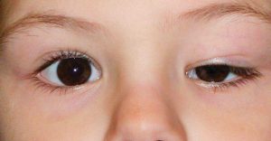 Read more about the article Queda das pálpebras pode afetar visão e causar cansaço visual.